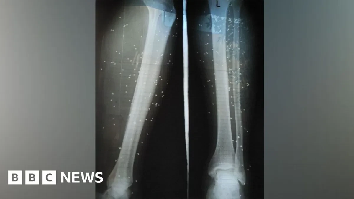 اسرار دولية | المتظاهرون الإيرانيون يتلقون علاجاً سرياً خوفاً من الاعتقال بعد إصابتهم